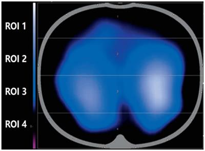 Effect of individualized positive end-expiratory pressure based on electrical impedance tomography guidance on pulmonary ventilation distribution in patients who receive abdominal thermal perfusion chemotherapy